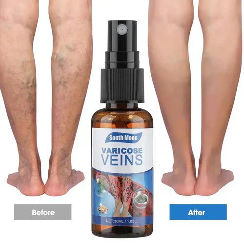 Last Day Of Discount π₯ Varicose Veins Spray